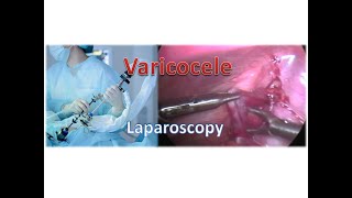 Varicocele - Laparoscopic surgery - #shorts