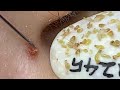 Satisfying With Loan Nguyen Spa Video (#066) #acnetreatment