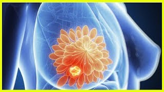 Эта диета предотвратит образование кист в груди Эта диета предотвратит образование кист в груди