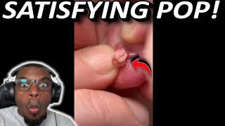 Short, But EXPLOSIVE Tiktok Pimple Pops! | Popping huge blackheads and Pimple Popping
