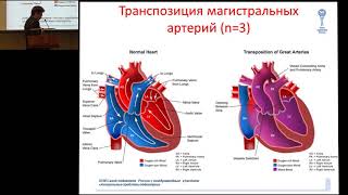 19.02.2017 - Критические пороки сердца в периоде новорожденности - мультидисциплинарный подход