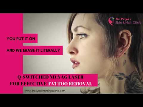 Laser Tattoo Removal Services | Vogue Lashes & Spa | Virginia Beach