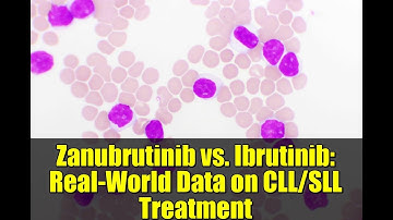 Zanubrutinib vs. Ibrutinib: Real-World Data on CLL/SLL Treatment