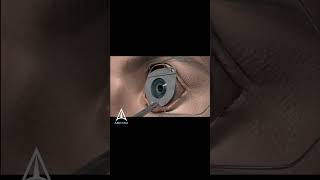 How LASIK eye surgery works l #shorts 3d #animation