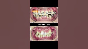 Cận cảnh quá trình niềng răng chen chúc mức độ 2