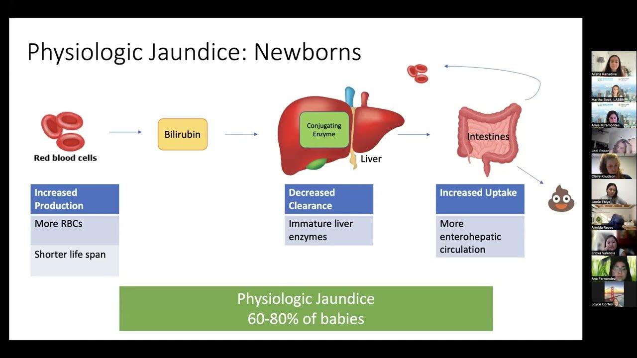 inar Neonatal Jaundice and Hyperbilirubinemia YouTube