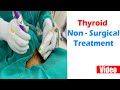 Non  surgical treatment for thyroid  citi vascular hospital  nonsurgicaltreatments thyroid