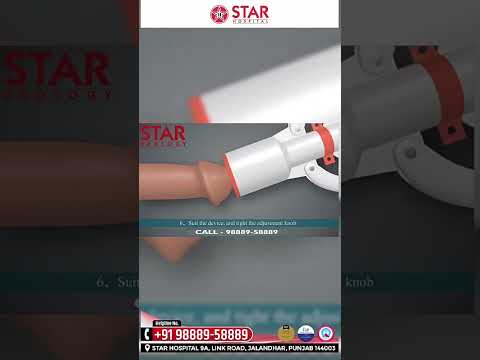 Dick Penis क खतन करव न च ह ए Dick Stapler Circumcision Bloodless Painless Fast Recovery 