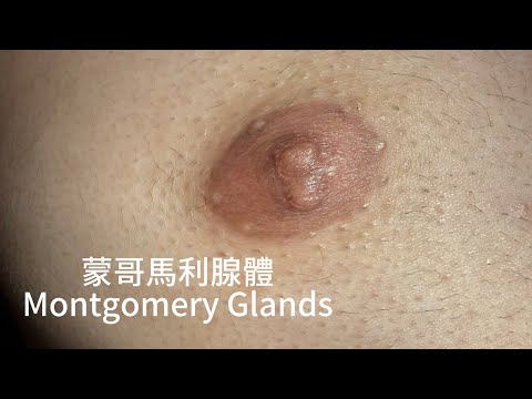 蒙哥馬利腺體 雷射清除乳暈上的顆粒 美麗新城診所莊禮謙醫師 Montgomery Glands, Dr George