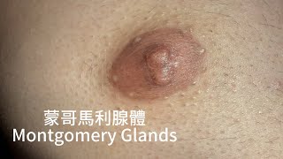 蒙哥馬利腺體 雷射清除乳暈上的顆粒 美麗新城診所莊禮謙醫師  Montgomery Glands, Dr George