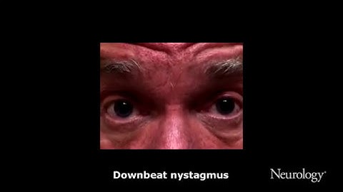 Teaching Video NeuroImages: Video-opthalmoscopy: Nystagmus from the inside [1/2]