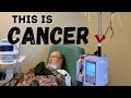 Bladder Cancer Blood Transfusion and Kidney Stint Removal Update