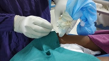 Radial Artery Access for Endovascular IR Procedures