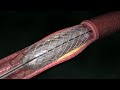 Coronary Artery Angioplasty ( Radial Access)