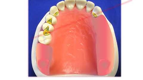 Maxillary Kennedy Class II Design Scenario