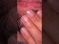 #ingrownhairremoval #removeingrown #satisfying #oddlysatisfying #asmr#blackheads