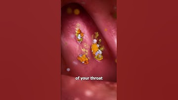 What Are Tonsil Stones? 🤔