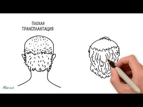 Пересадка волос FUE - сколько нужно графтов (Турция)