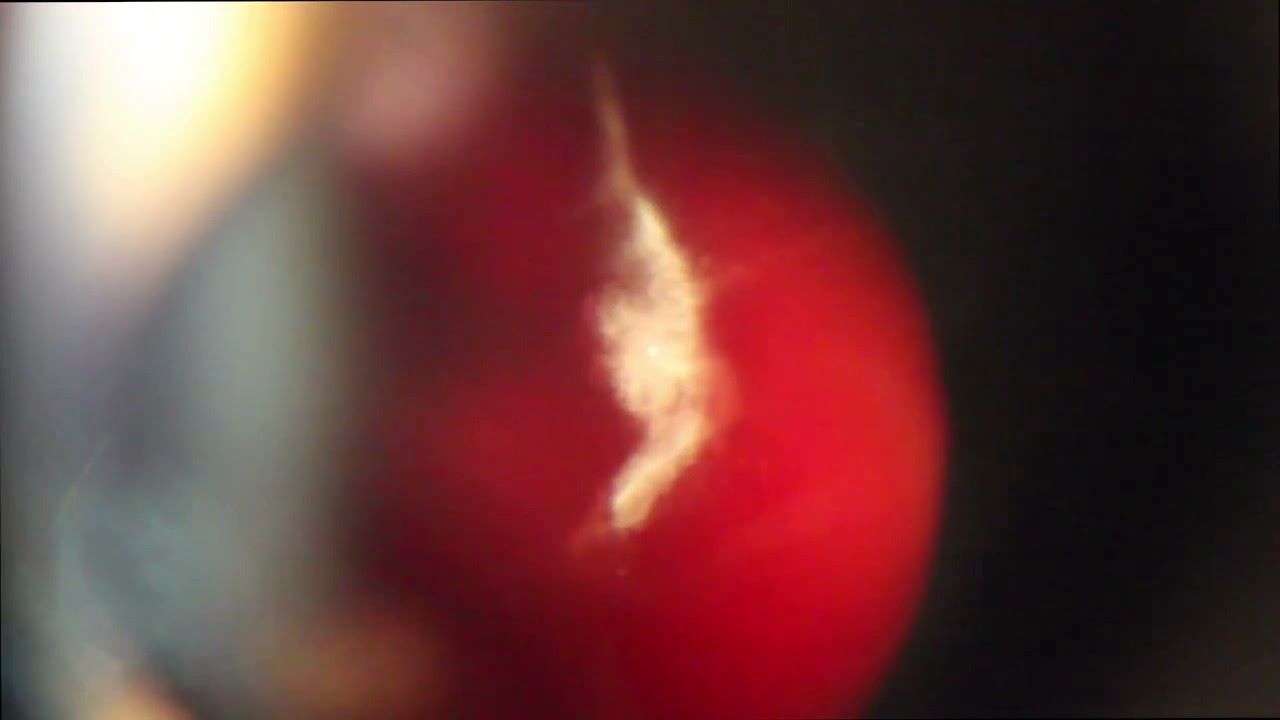 Процедура лазерного витреолизиса (лечение деструкции стекловидного тела ...