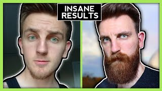 Minoxidil Beard Transformation - INSANE! (Chinstrap to Viking)