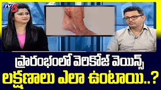 Health File: Varicose Veins Laser Treatment Dr. Rajah V Koppala | AVIS Hospitals | TV5 News Digital