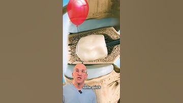 Innovative Spine Fracture Treatment: Balloon + Cement 🎈#shorts