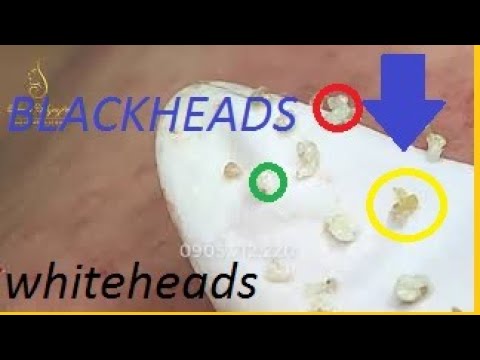 Remove Lots Of Hidden Pimples Blackheads And Whiteheads For Girls