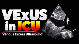 Vexus In Icu Venous Excess Ultrasound A Practical Approach To Venous Congestion