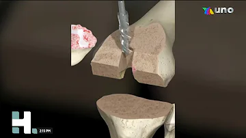 ¿Qué hueso se extrae durante una operación de rodilla?