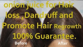 Onion Juice & Olive Oil for hair regrowth before after 100%proved hair Treatment 2018 Amazing result