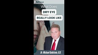 Understanding Dry Eye: Why Excessive Tears Can Indicate Underlying Issues – by East Hartford Eye Dr