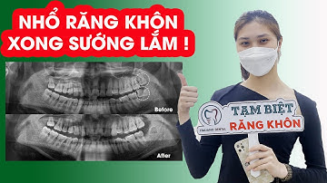 Cô gái dũng cảm nhổ cùng lúc 2 chiếc răng khôn mọc lệch 90 độ và mọc lệch má