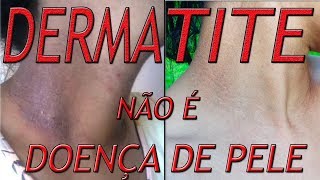 Leve fotos de dermatite de estase
