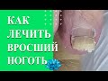 Титановая нить. Вросший ноготь на ноге. Коррекционная система.