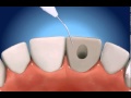 Root canal therapy rct  the gentle dentist