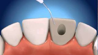 Root Canal Therapy (RCT)  The Gentle Dentist