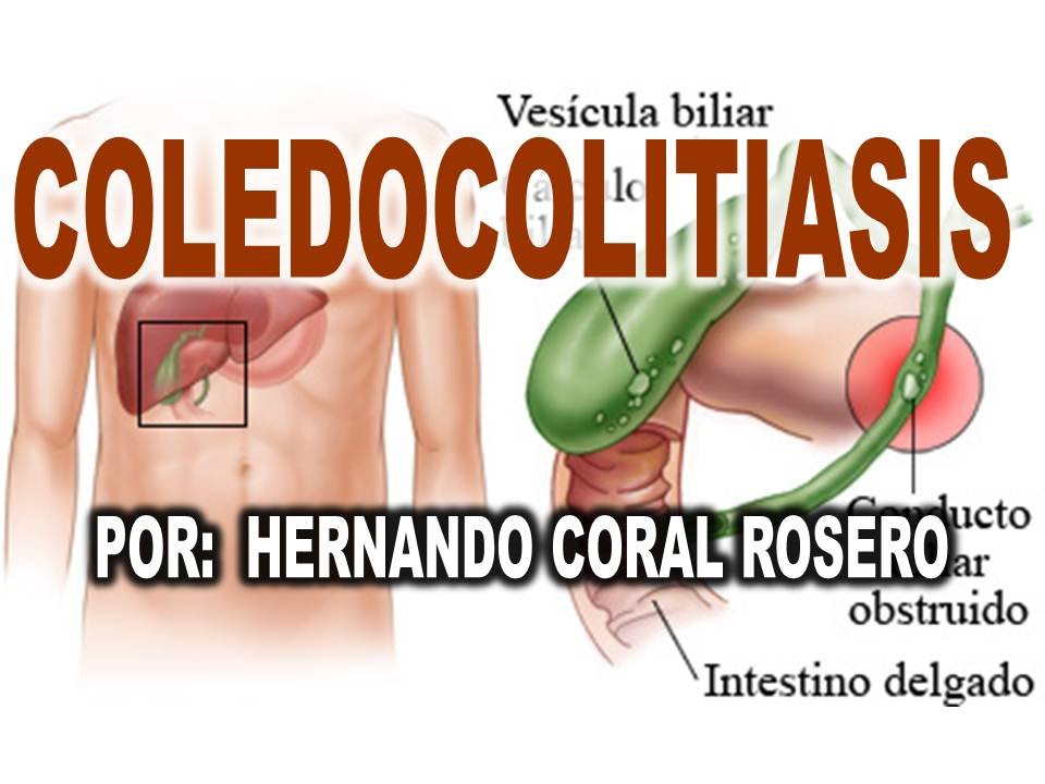 COLEDOCOLITIASIS - CÁLCULOS EN EL CONDUCTO BILIAR COLEDOCO - YouTube