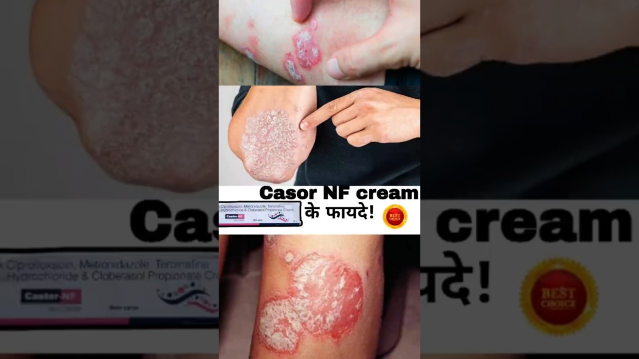 I Tried Castor NF Cream for My Fungal Infection