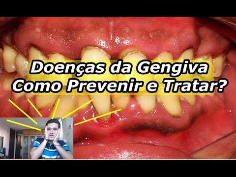 Vídeo: 4 maneiras de prevenir a doença gengival