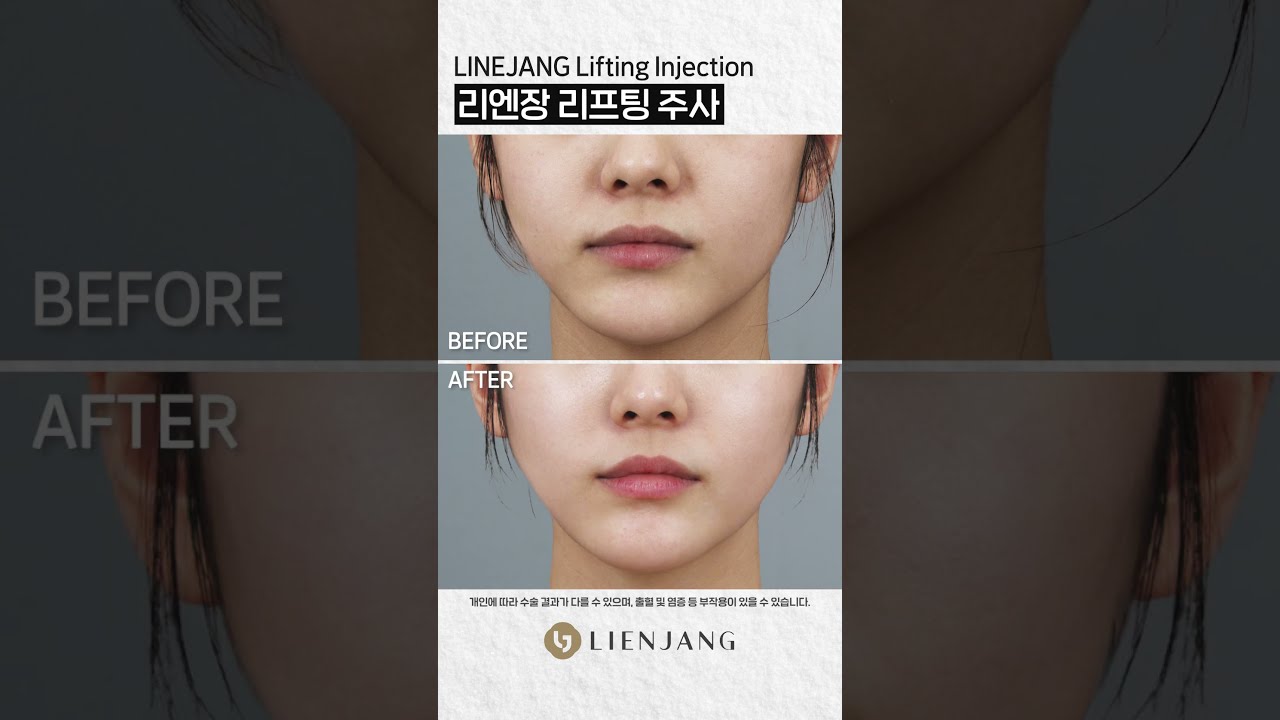 Риенжанг Гоо Сайхны Мэс Заслын Эмнэлэг: Лифтинг #богино_бичлэг