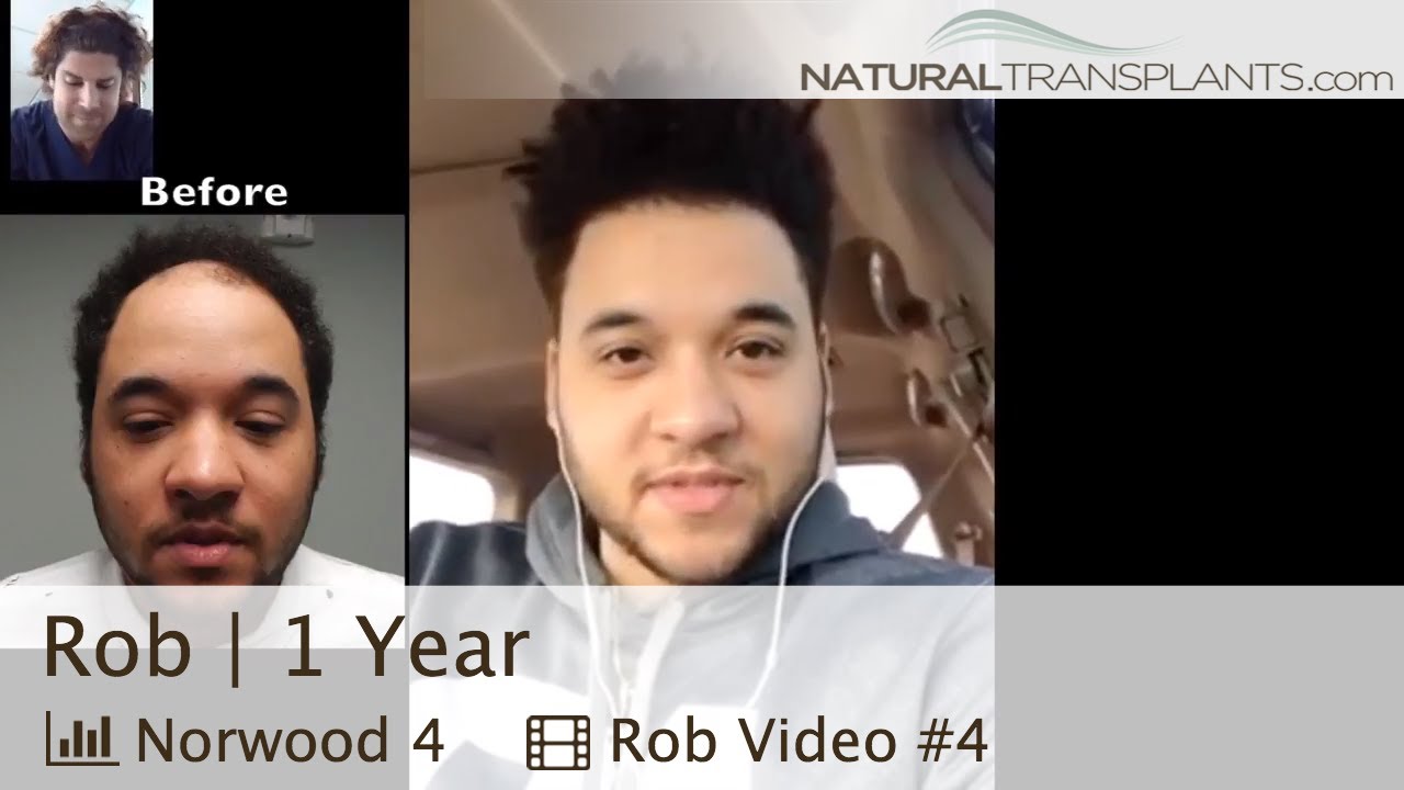 fue hair transplant month by month Hair Transplant Result 2018 | Hair Transplant After Surgery | Non FUE Hair Transplant (Rob)