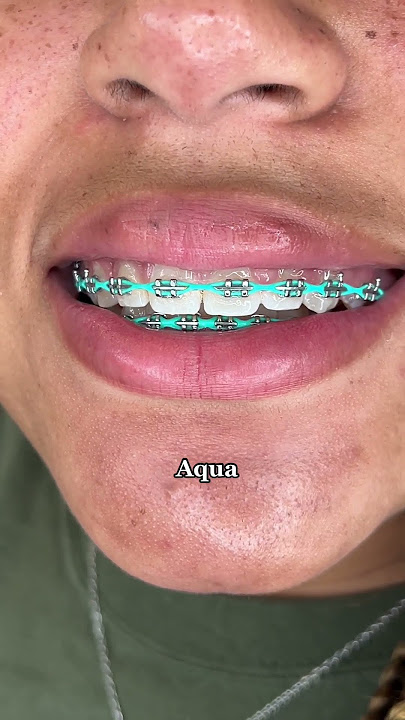 Best Braces Colors if you have Red Hair