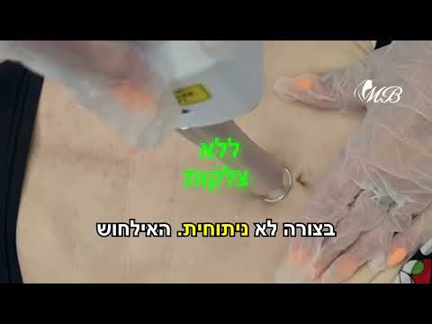 ד"ר מאיר באבאיב - מיצוק עור הבטן עם לייזר UltraClear