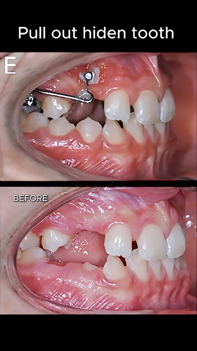 Pull out hiden tooth #braces #orthodontist #dentist