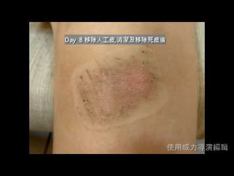 傷口保健室│小朋友犁田8日紀錄