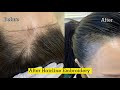 Hairline Microblading Malaysia | Microblading Receding Hairline | Semi Permanent Makeup