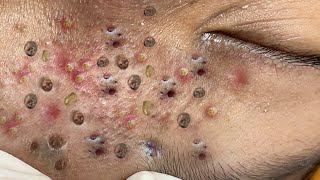 Deep Acne Cleaning – So Calming & Satisfying #1