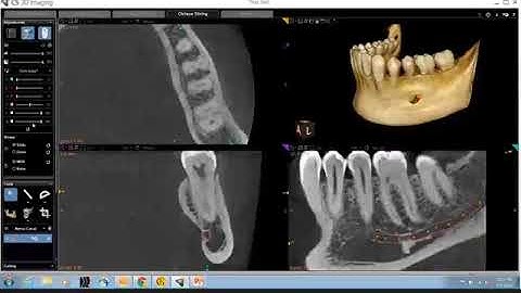 CS 3D Imaging- Review of Mandible