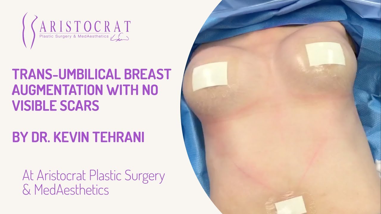 transumbilical breast augmentation surgeon Anal sphincter spasms