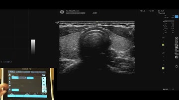 LOGIQ P9 Tutorials: Virtual Convex